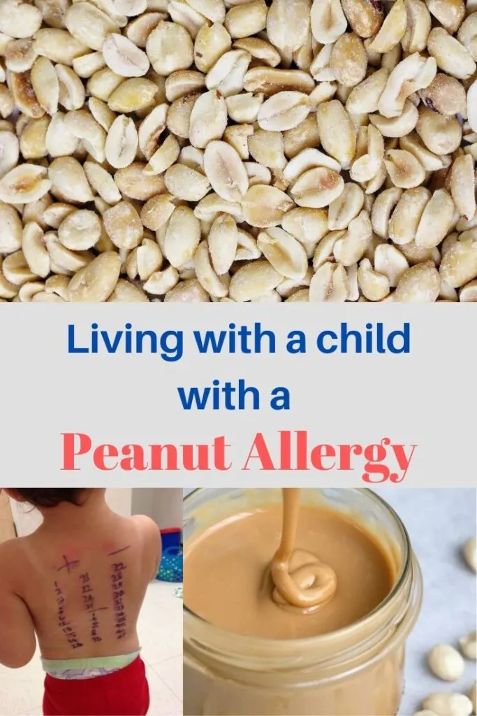 living with a child with a peanut allergy